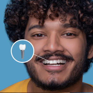 Implantes Dentários